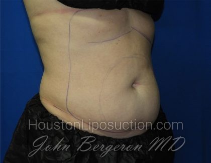 Liposuction Before & After Patient #3220