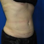 Liposuction Before & After Patient #3220