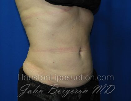 Liposuction Before & After Patient #3220