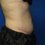 Liposuction Before & After Patient #3220