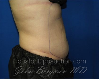 Liposuction Before & After Patient #3220