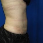 Liposuction Before & After Patient #3220