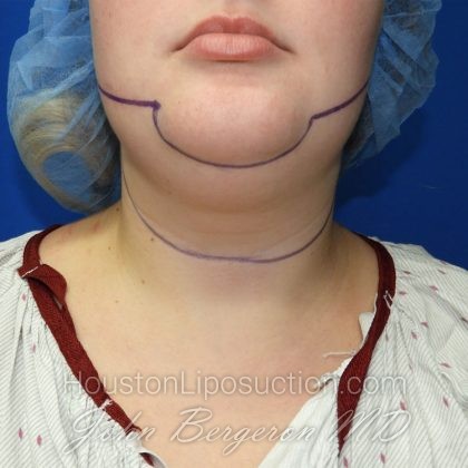 Liposuction Before & After Patient #3233