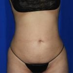 Liposuction Before & After Patient #3275