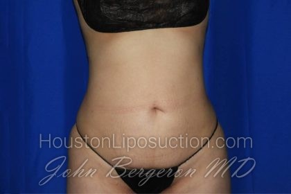 Liposuction Before & After Patient #3275