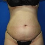 Liposuction - Abdomen / Flanks Before and After Pictures Case 14, Coeur  d'Alene, ID