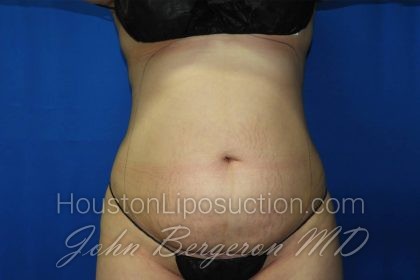 Liposuction Before & After Patient #3275