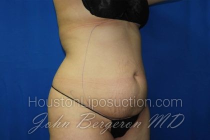 Liposuction Before & After Patient #3275