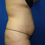 Liposuction Before & After Patient #3275