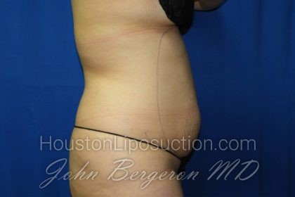 Liposuction Before & After Patient #3275