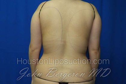 Liposuction Before & After Patient #3275