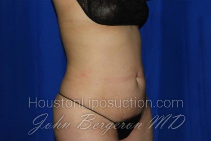 Liposuction Before & After Patient #3275