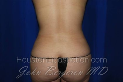 Liposuction Before & After Patient #3275