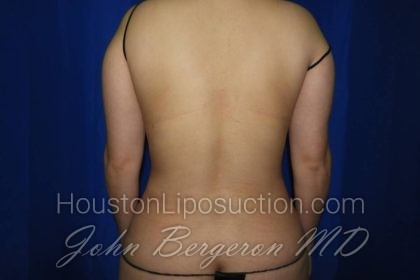 Liposuction Before & After Patient #3275