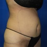 Liposuction Before & After Patient #3272