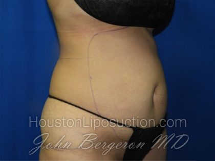 Liposuction Before & After Patient #3272