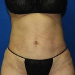 Liposuction Before & After Patient #3272