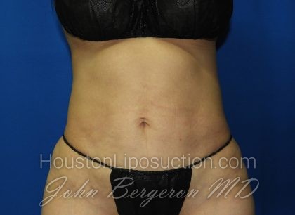 Liposuction Before & After Patient #3272