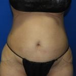 Liposuction Before & After Patient #3272