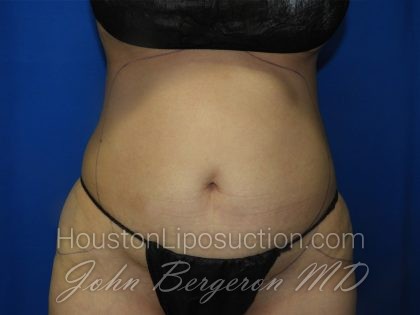 Liposuction Before & After Patient #3272