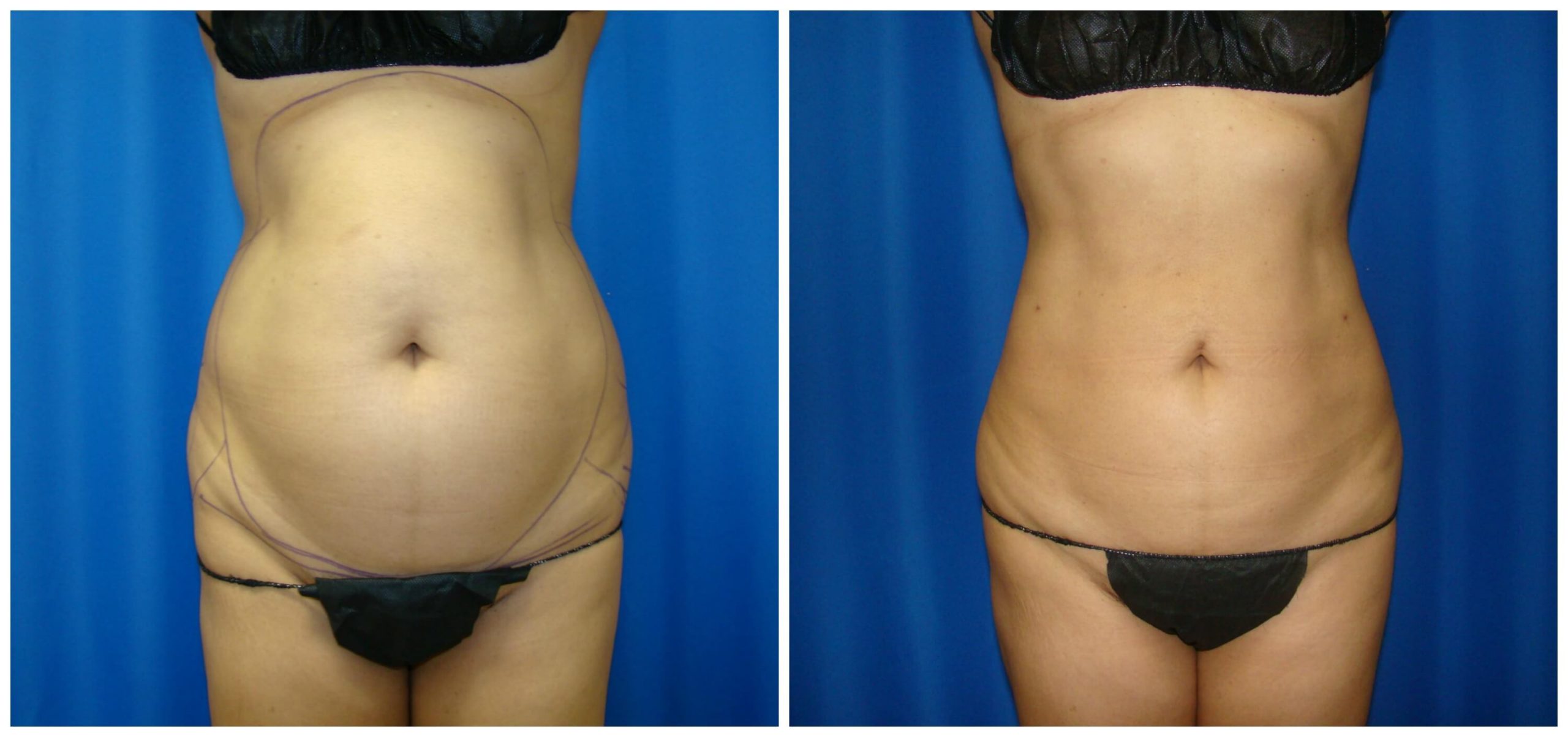 Waist & Hip Liposuction / Houston Lipo Center