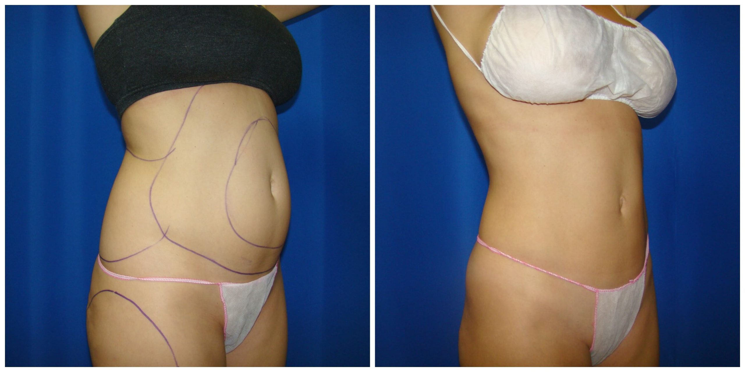 Waist & Hip Liposuction / Houston Lipo Center