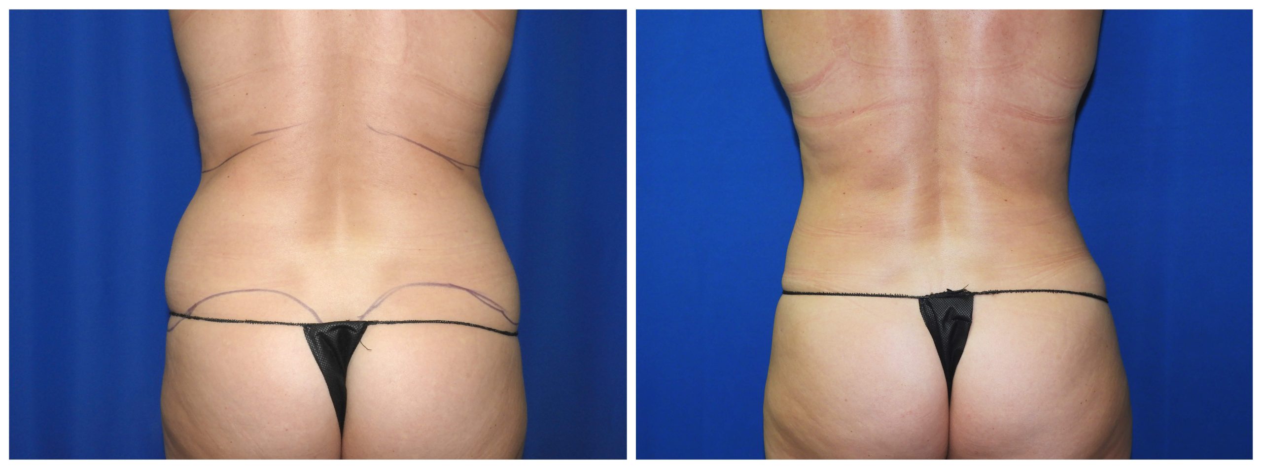 Waist & Hip Liposuction / Houston Lipo Center