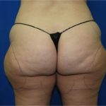Liposuction Before & After Patient #3340