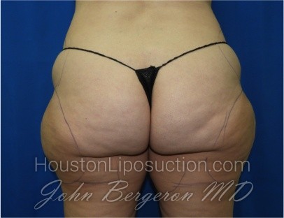 Liposuction Before & After Patient #3340