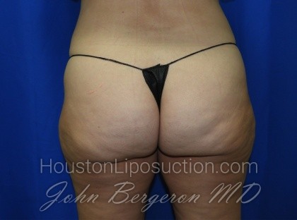 Liposuction Before & After Patient #3340