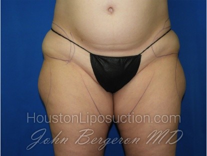 Liposuction Before & After Patient #3340