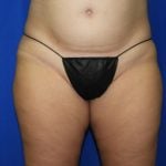 Liposuction Before & After Patient #3340