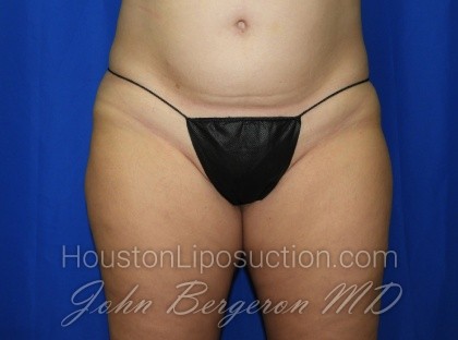 Liposuction Before & After Patient #3340