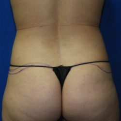Liposuction Before & After Patient #3331