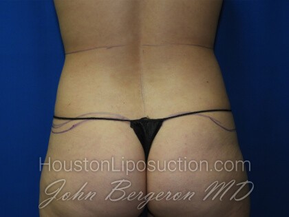 Liposuction Before & After Patient #3331