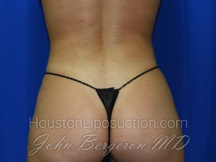 Liposuction Before & After Patient #3331