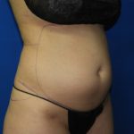 Liposuction Before & After Patient #3331