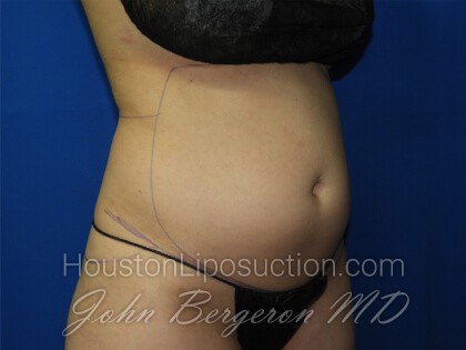 Liposuction Before & After Patient #3331