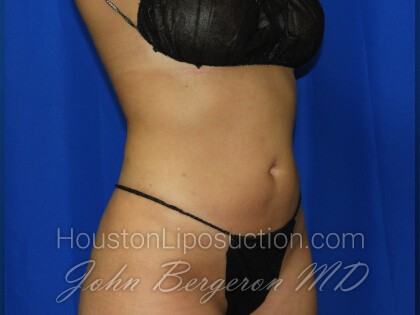 Liposuction Before & After Patient #3331