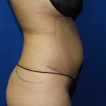 Liposuction Before & After Patient #3331