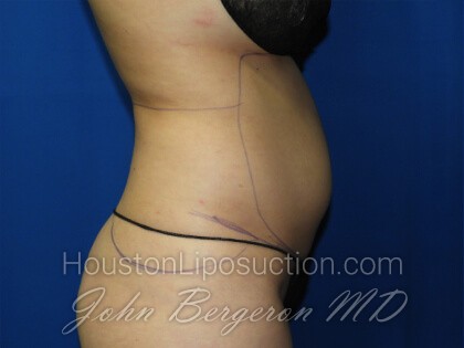 Liposuction Before & After Patient #3331