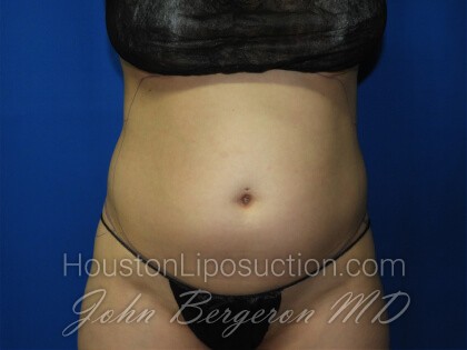 Liposuction Before & After Patient #3331