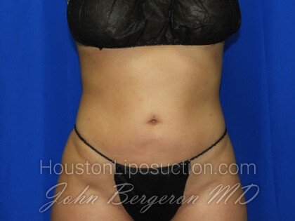Liposuction Before & After Patient #3331