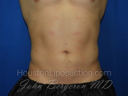 Liposuction Before & After Patient #3366