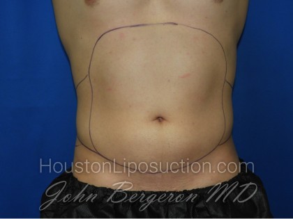 Liposuction Before & After Patient #3366