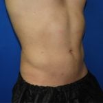 Liposuction Before & After Patient #3366