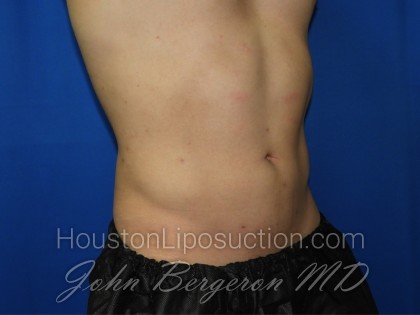 Liposuction Before & After Patient #3366