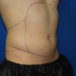 Liposuction - Abdomen / Flanks Before and After Pictures Case 14, Coeur  d'Alene, ID