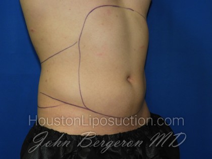 Liposuction Before & After Patient #3366