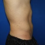 Liposuction Before & After Patient #3366